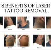 Laser Tattoo Removal