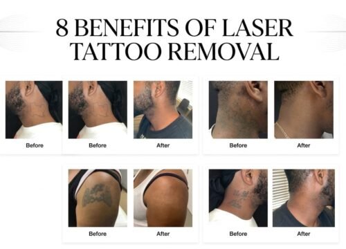 Top 8 Benefits of Laser Tattoo Removal to Know