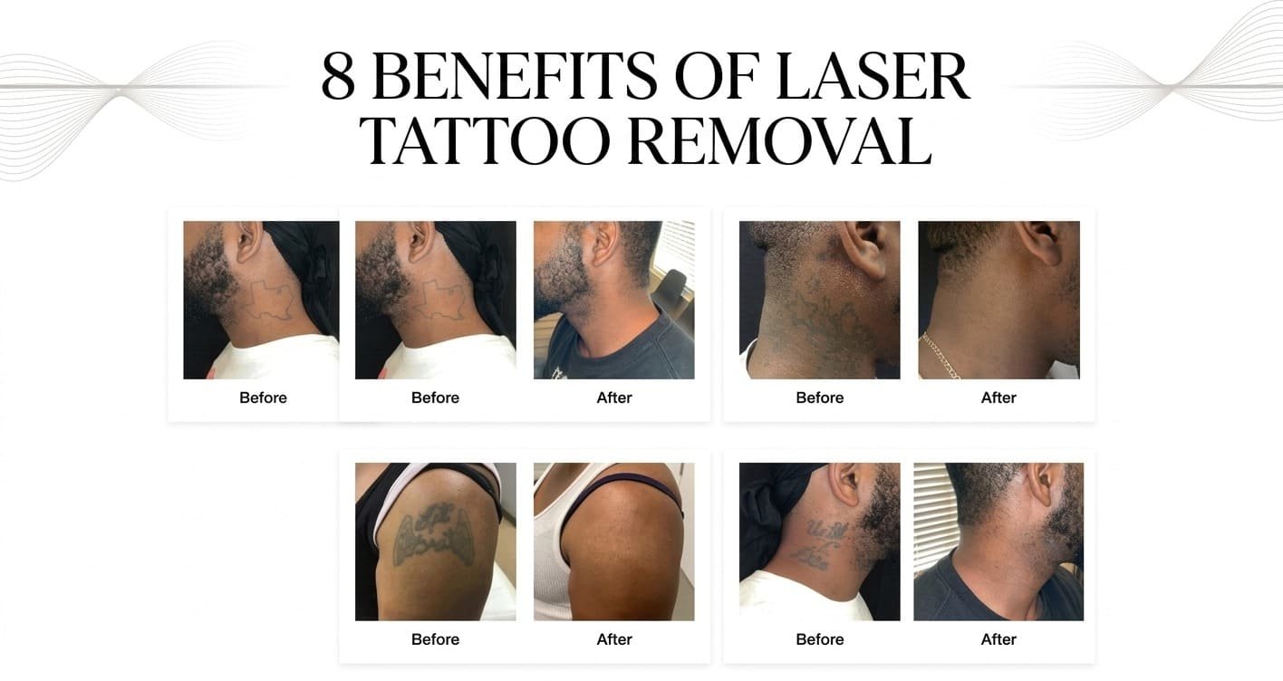 Laser Tattoo Removal